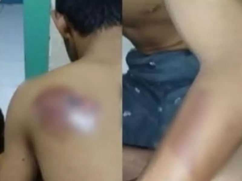 Santri Difabel di Gresik Jadi Korban Bully, Punggung Disetrika Senior