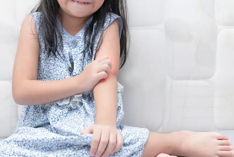 Kenapa Kasus Alergi pada Anak Semakin Banyak? Ini Penjelasan Dokter